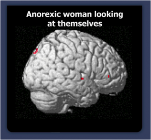 Anorexic woman looking at themselves